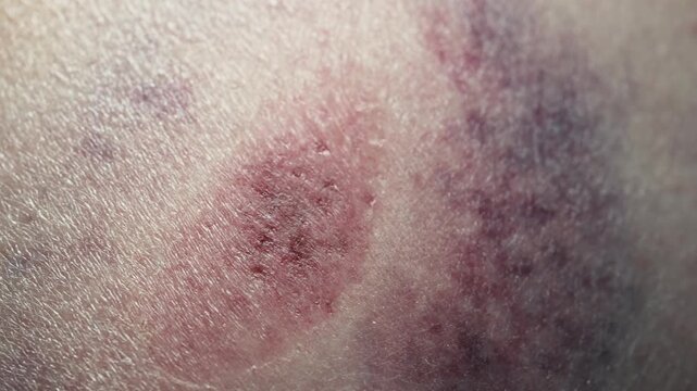 Bruise and Hematoma After Impact on Human Skin &mdash; Medical 3D Animation