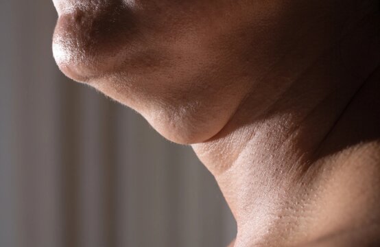 Woman With Double Chin and Submental Fullness, Jawline Skin and Fat Macro Close-Up