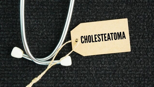 Stethoscope and paper tag with the word cholesteatoma is an abnormal, non-cancerous skin growth or cyst that develops in the middle ear behind the eardrum.