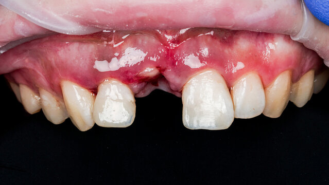 Close-up clinical view of the upper front teeth and gums showing traumatic injury, redness, swelling and bleeding of the gingival tissue.Dental trauma, oral injury, tooth damage