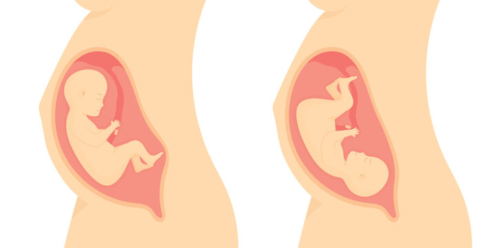Pregnant woman with breech and cephalic fetal presentation medical illustration set