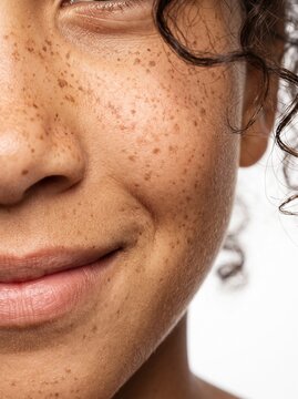 Close-up of a smiling young person with dense natural freckles on the cheek and curly hair, joyful expression and freckled skin
