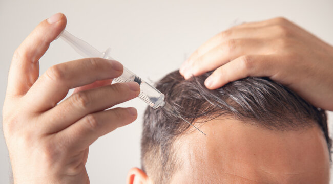 Making injection in the man head for hair growth.