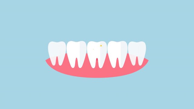 Dental implant procedure animation showing tooth replacement in gums