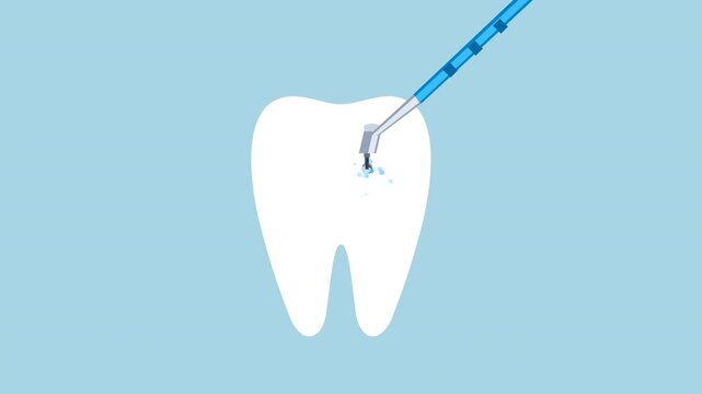 Dental procedure showing cavity treatment on human teeth icons