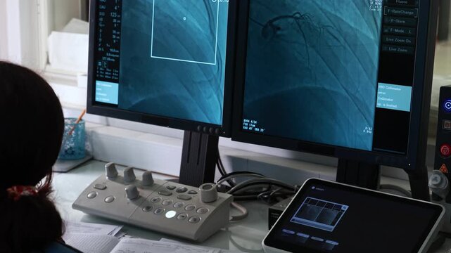 Coronary angiography, faceless specialist watching live angiogram of heart vessels on monitors in cath lab control room, patient and medical staff in background