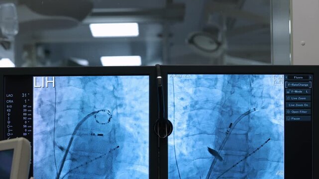Interventional cardiology control room, medical screens with real-time x-ray images of catheters in heart chambers and angiography system interface