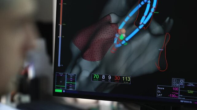 Doctor watching 3D electroanatomical map of the heart on screen during cardiac electrophysiology study, catheter and voltage map in EP lab