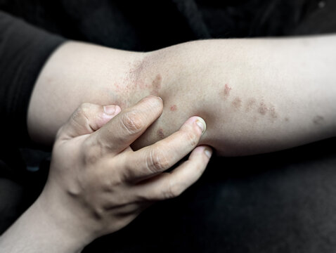Person touching skin rash on inner elbow area with hand in close up view with touches red irritated located inner inflammation dermatology examination dermatitis irritation condition sensitive