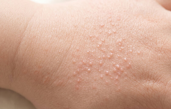 Close Up of Clustered Water Blisters Pompholyx Eczema and Allergic Contact Dermatitis Rash