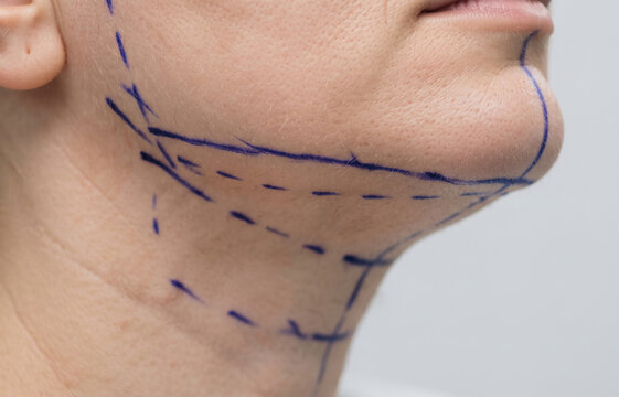 Close Up of Preoperative Blue Surgical Markings on Female Patient Jawline and Neck