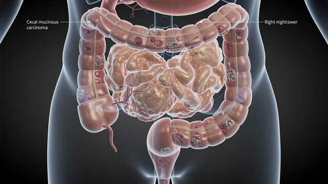 3D Render of Cecal Mucinous Carcinoma and Multiple Colonic Polyps, Gastrointestinal Cancer Illustration