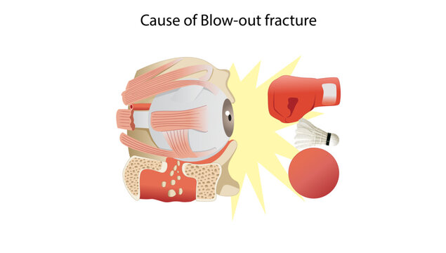 Cause of Blow-out fracture, Medical illustration demonstrating the mechanism of a blow-out fracture caused by blunt trauma to the eye, showing impact force transmitted to the orbital region.
