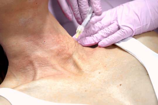 Detailed view of facial procedure applying tiny needle punctures for skin renewal