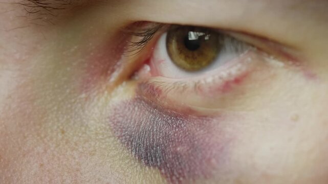 Close up of bruised eye with purple and black discoloration.