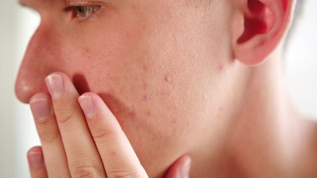Acne breakouts  on a young man&rsquo;s cheek with skin texture blemishes. Men&rsquo;s hand goes over his face with red inflammatory papules. Men&rsquo;s skin care. Boy with acne.