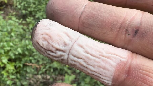   
Close-up of frostbitten white finger, winter cold injury, human hand detail showing frozen skin tone, medical and survival concept in harsh environment