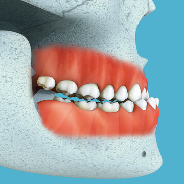 Underbite.,class 3 Malocclusion. Medically accurate orthodontic 3D illustration.
