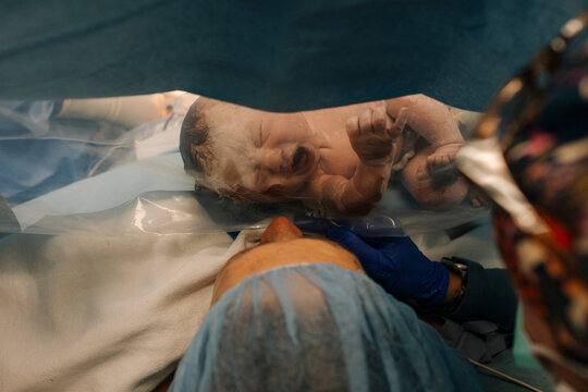 A newborn baby sees her mother for the first time after delivery.