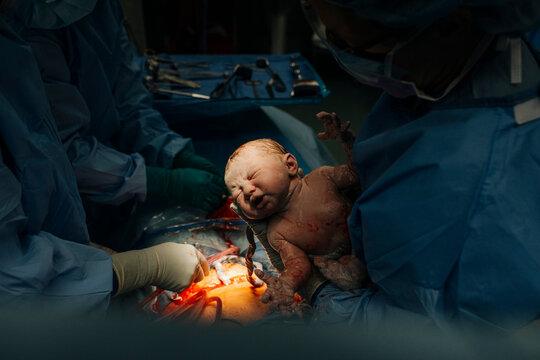 A baby is born by c-section in an operating room.