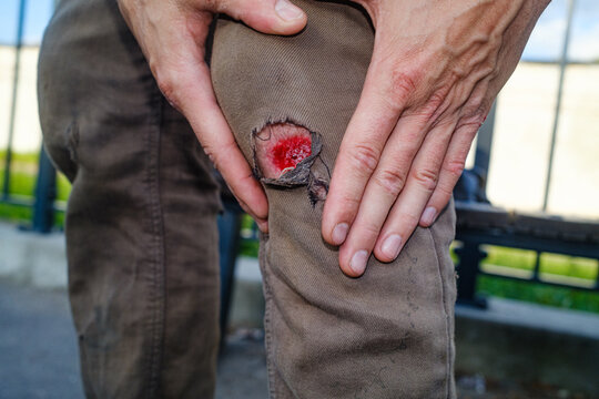 Person With Injured Knee Showing Damage on Pants in Outdoor Area