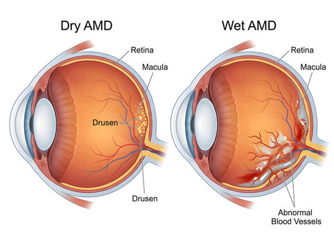 Comparison of dry and wet age-related macular degeneration isolated on white background