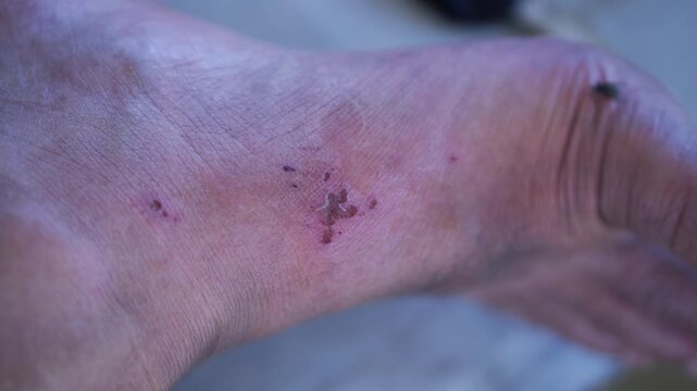 Close up view of a scratch mark and red skin irritation on a human ankle.