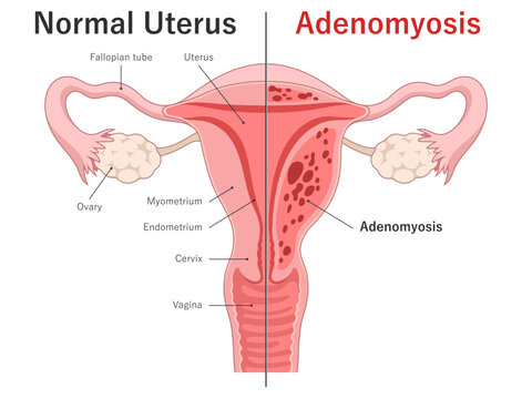 Adenomyosis vs normal uterus medical diagram. Uterus cross section. 
