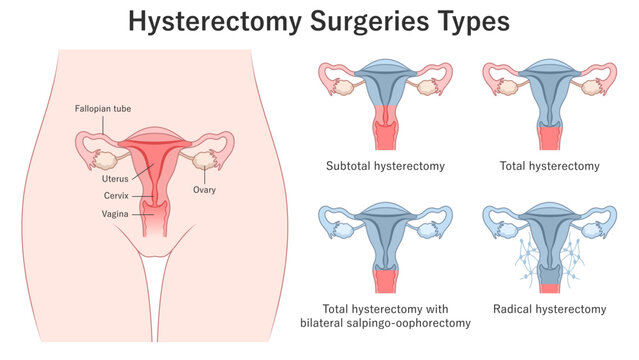 Hysterectomy Surgery Types. Partial, total, radical. Medical illustration. 