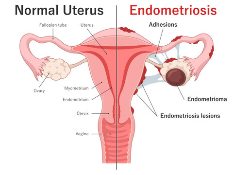 Endometriosis vs normal uterus medical diagram. Uterus cross section. Endometrioma.