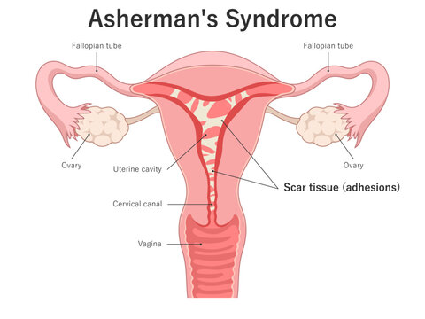 Asherman's Syndrome. Intrauterine adhesions inside the uterus. Medical illustration.