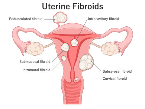 Main Types of Uterine Fibroids. Medical illustration. Uterus cross section. Intramural, submucosal, subserosal, pedunculated fibroids.