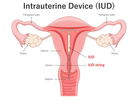 Intrauterine device (IUD) inside uterus. Medical illustration.