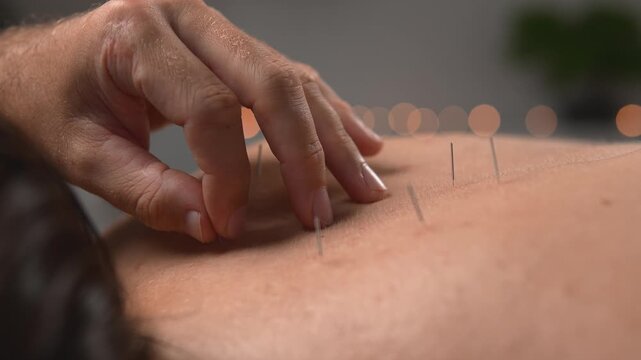 A massage therapist positions another acupuncture needle with precise fingertips. The macro detail view presents targeted treatment, holistic health and client comfort for lifestyle media.