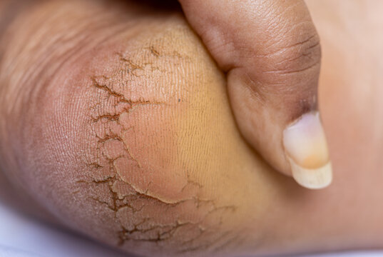 A woman touch dried crack heel. Close up deep crack dry heel of an Indian woman foot with rough dead skin is covered with cracks. Dried crack skin problem.