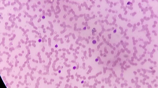 Acute leukaemia (AL). Microscopic footage. WBC shows left shift, atypical looking large mononuclear cells with 1-2 nucleoli.