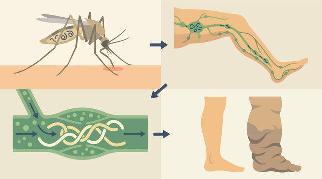 Lymphatic filariasis elephantiasis life cycle diagram. Mosquito bite parasite transmission vector set. Swollen leg disease medical infographic.