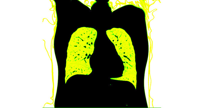 Radiology CT image of the thorax reveals clear, healthy lungs. Rendered in yellow-toned for enhanced visualization. Ideal for clinical education.