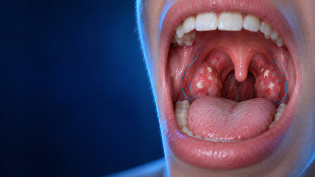 Tonsillitis in Palatine Tonsils With AI-Assisted Planning Overlay, Photorealistic ENT Healthcare Technology View of Inflamed Throat Anatomy With Clinical Interface for Medical and Patient Education