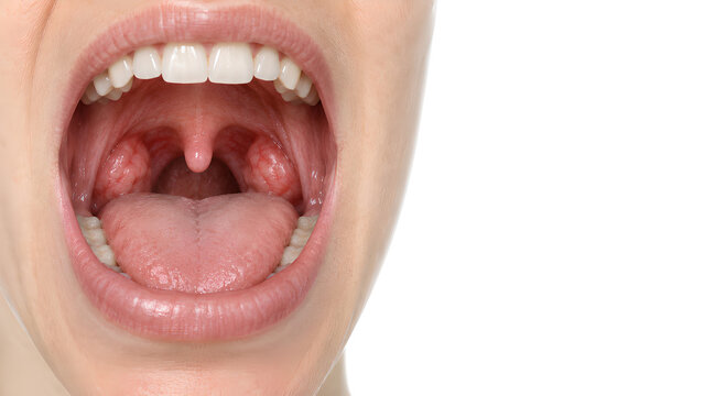 Palatine tonsils with mild tonsillitis concept in an open mouth, photorealistic medical education image on a white background with copy space for ENT care, patient information and healthcare design