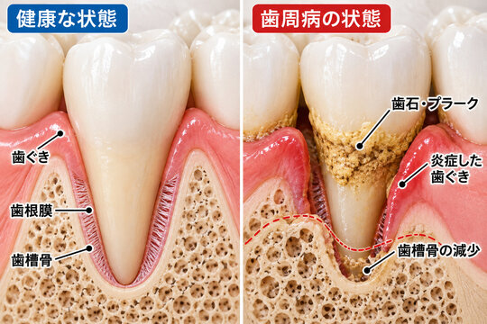 健康な歯と歯周病の断面比較