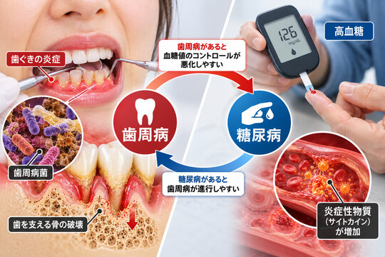 歯周病＋糖尿病の関係