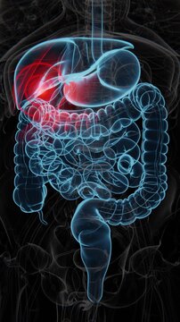 Gallstone pain is discomfort caused by gallstones blocking the bile ducts, often felt in the upper right or upper middle abdomen | Gallstone pain indication Video in UHD