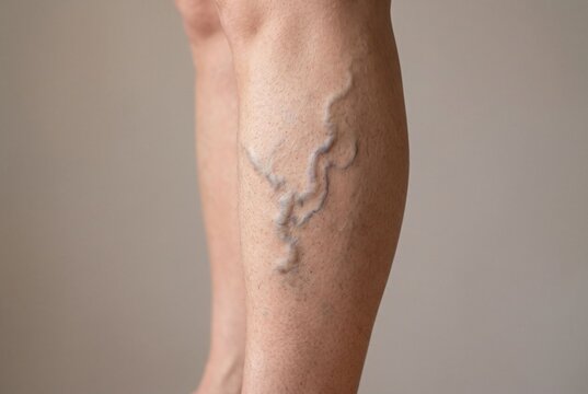 Close-up of human leg calf showing visible varicose veins on healthy skin