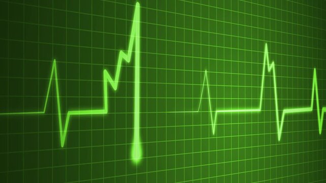 Abnormal heart rhythm line showing an ekg style medical waveform animation