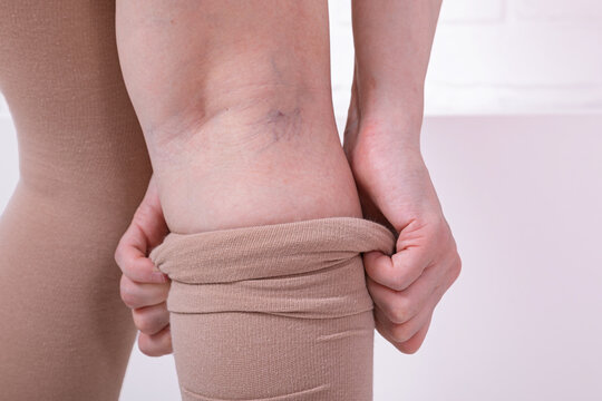 Hands pulling up a compression stocking over a leg with visible varicose veins. Varicose vein care and circulation support. Medical hosiery for venous health. Compression therapy