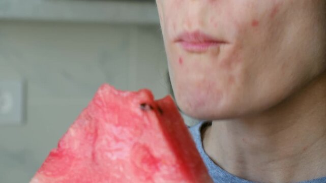 Close up young person with acne and pimples on face eating juicy slice of red watermelon, highlighting skin problems and diet concepts for healthy lifestyle. Woman with problem skin eating watermelon