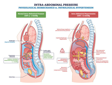 Intra-abdominal pressure biomechanics vs hypertension shown side-by-side, contrasting normal and pathological states, arrows highlight diaphragm, spine, and abdominal organs. Outline diagram