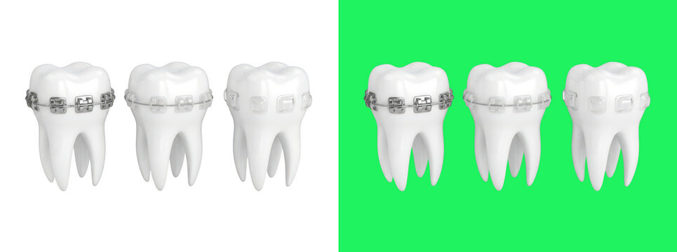 Three white teeth with metal braces 3D