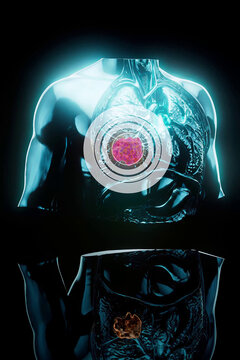 Conceptual 3D illustration of lung cancer and tumor growth in the lungs